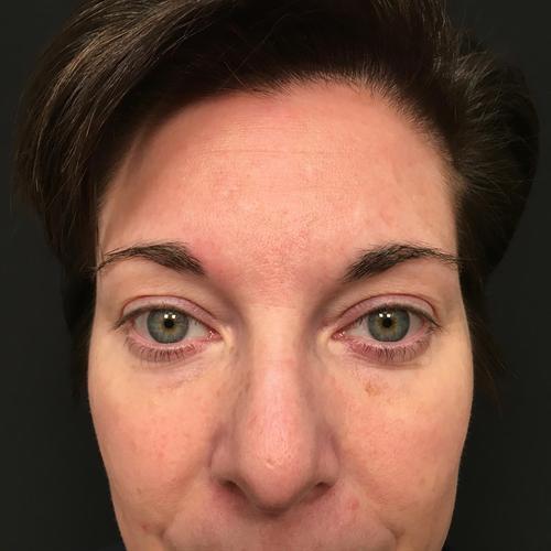 Blepharoplasty Before & After Image