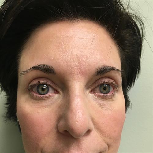 Blepharoplasty Before & After Image