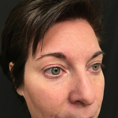 Blepharoplasty Before & After Image