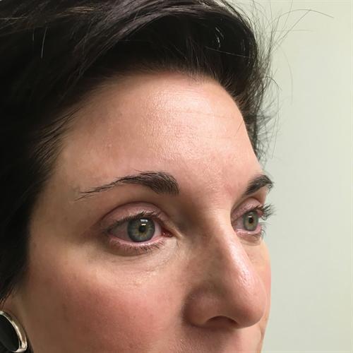 Blepharoplasty Before & After Image