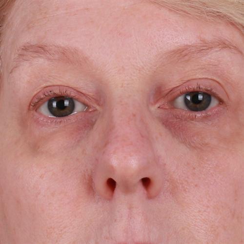 Blepharoplasty Before & After Image