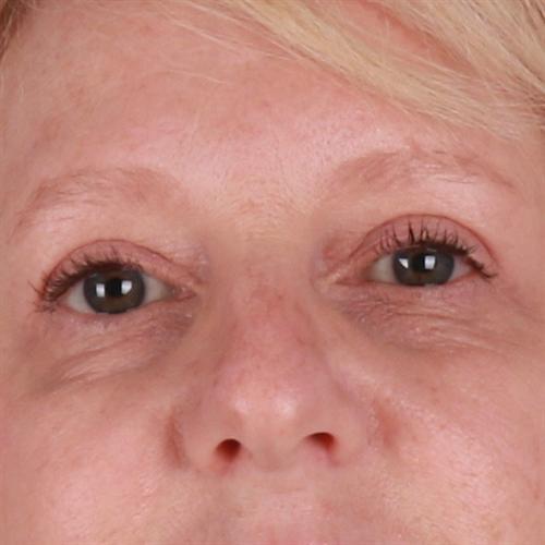 Blepharoplasty Before & After Image