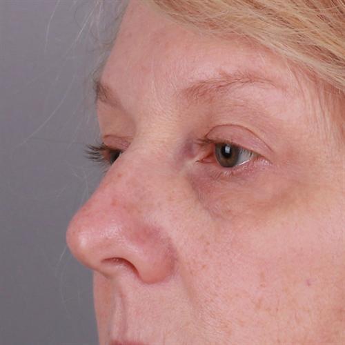 Blepharoplasty Before & After Image