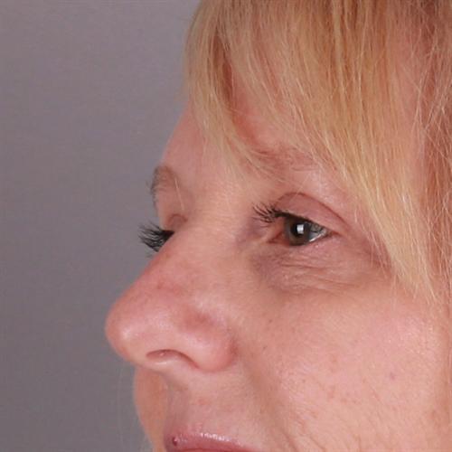 Blepharoplasty Before & After Image