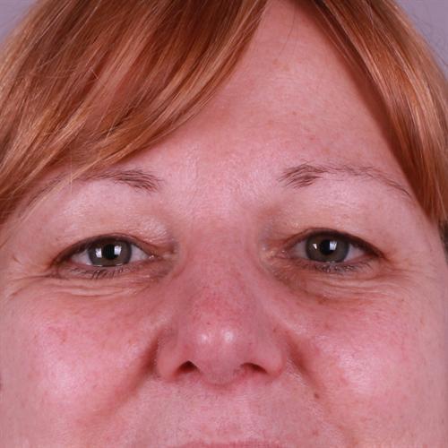 Blepharoplasty Before & After Image