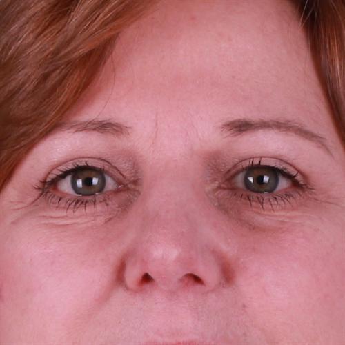 Blepharoplasty Before & After Image