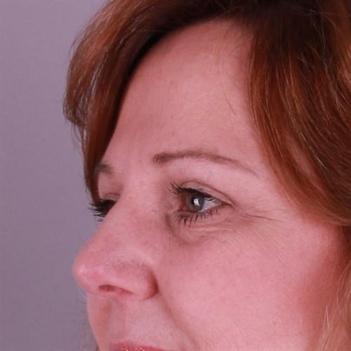 Blepharoplasty Before & After Image