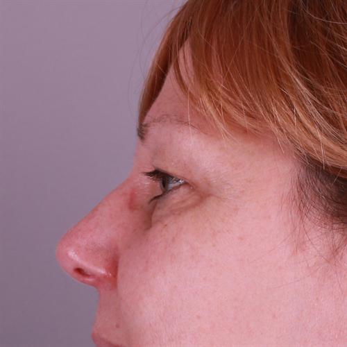 Blepharoplasty Before & After Image