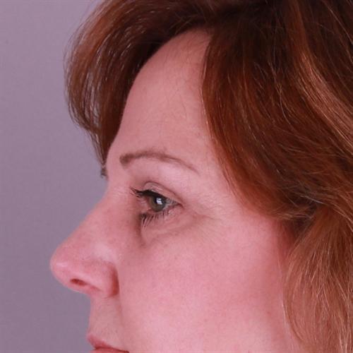 Blepharoplasty Before & After Image