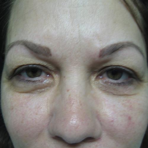 Blepharoplasty Before & After Image