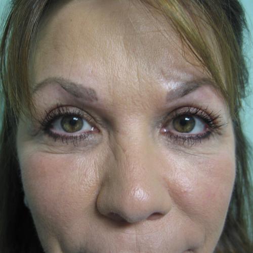 Blepharoplasty Before & After Image