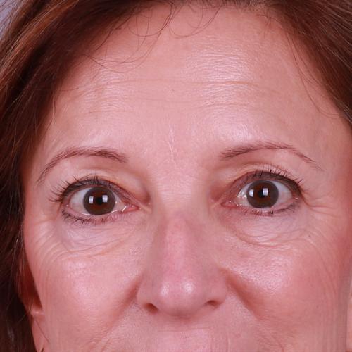 Blepharoplasty Before & After Image