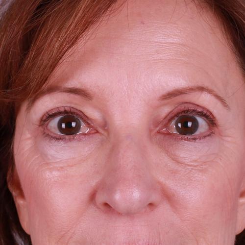 Blepharoplasty Before & After Image