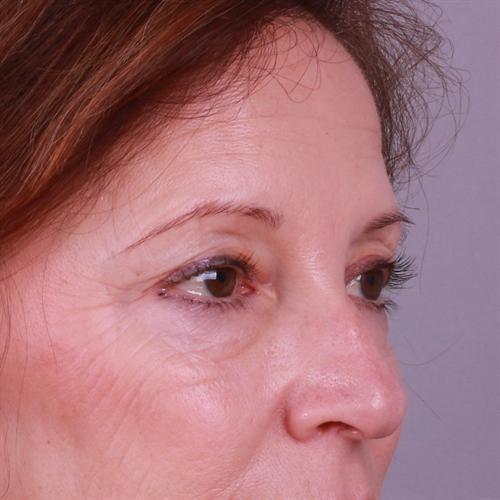 Blepharoplasty Before & After Image