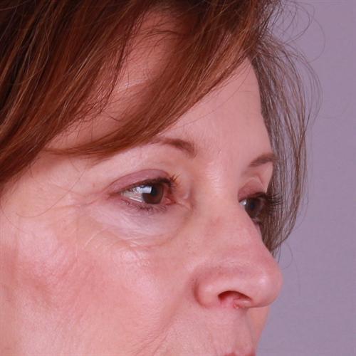 Blepharoplasty Before & After Image