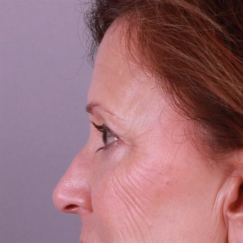 Blepharoplasty Before & After Image