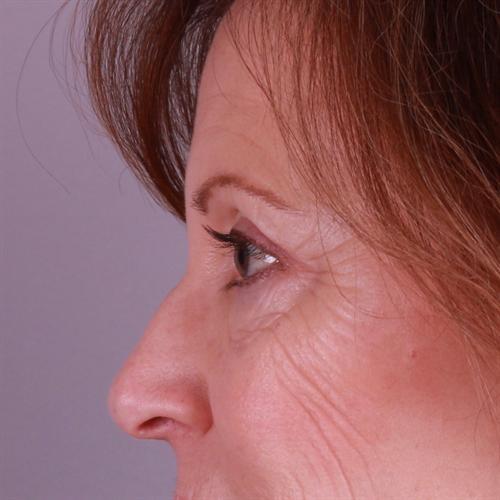 Blepharoplasty Before & After Image