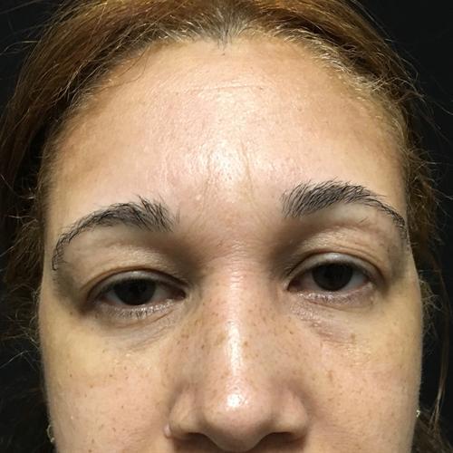 Blepharoplasty Before & After Image