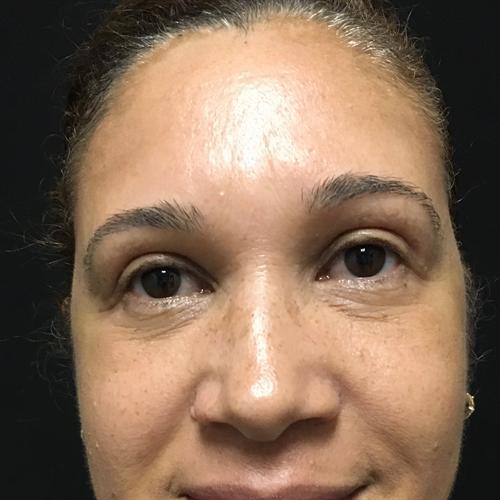 Blepharoplasty Before & After Image