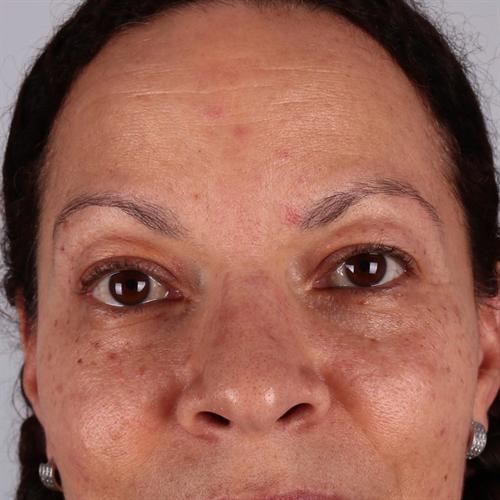 Blepharoplasty Before & After Image