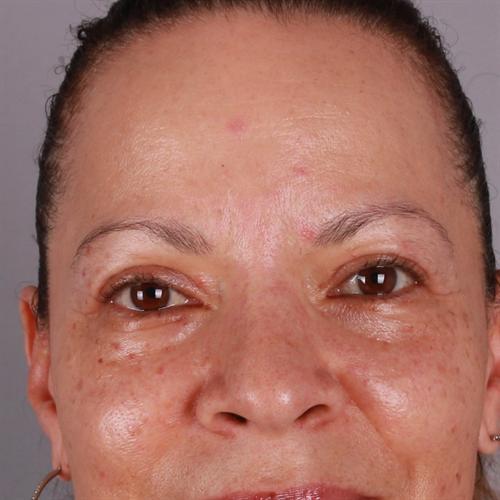 Blepharoplasty Before & After Image