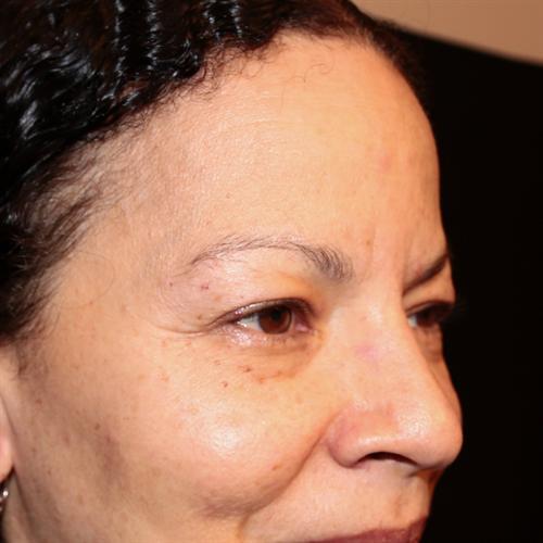 Blepharoplasty Before & After Image