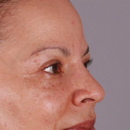 Blepharoplasty Before & After Image