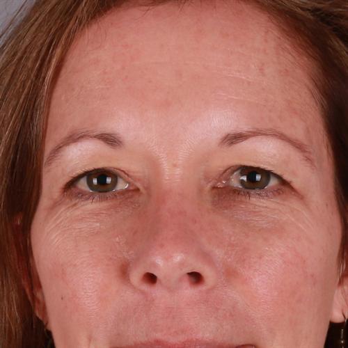 Blepharoplasty Before & After Image