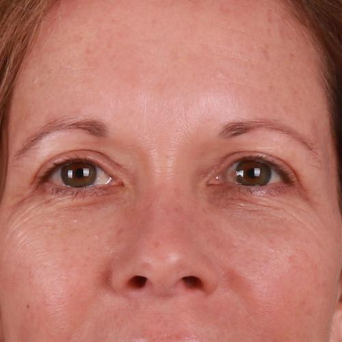 Blepharoplasty Before & After Image