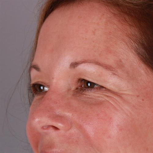 Blepharoplasty Before & After Image