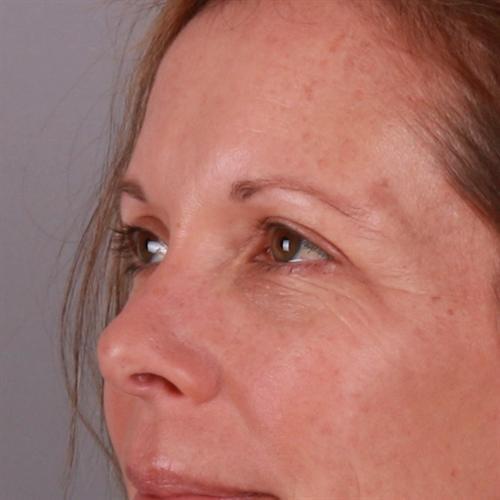 Blepharoplasty Before & After Image