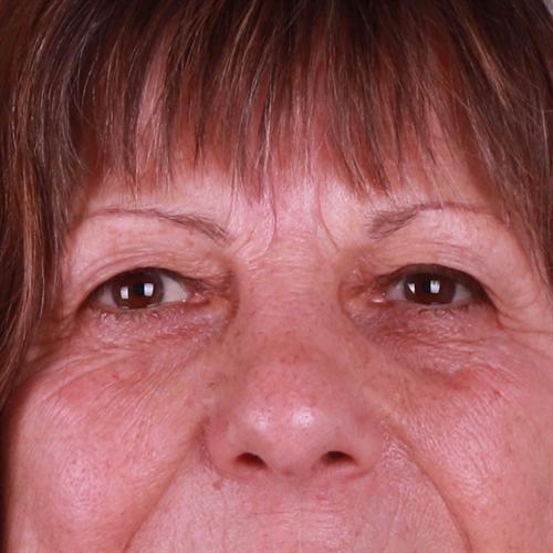 Blepharoplasty Before & After Image