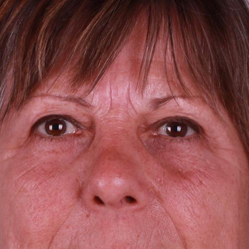 Blepharoplasty Before & After Image