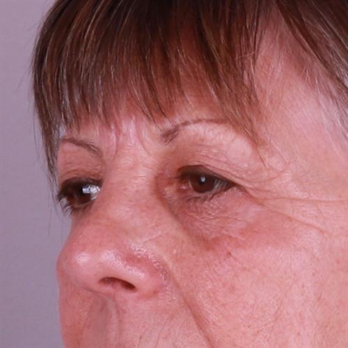 Blepharoplasty Before & After Image