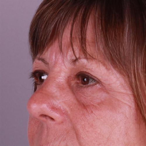 Blepharoplasty Before & After Image