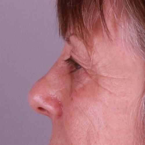 Blepharoplasty Before & After Image