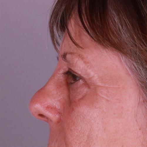 Blepharoplasty Before & After Image