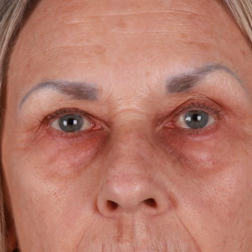 Blepharoplasty Before & After Image