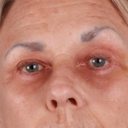 Blepharoplasty Before & After Image