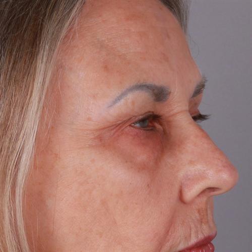 Blepharoplasty Before & After Image