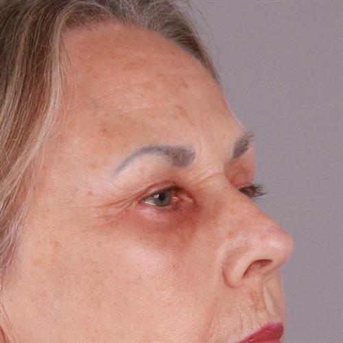 Blepharoplasty Before & After Image