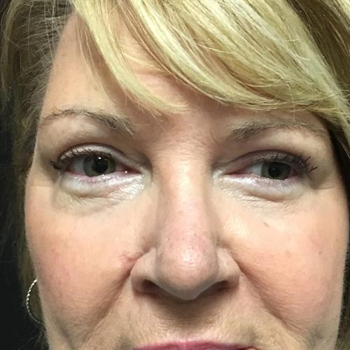 Blepharoplasty Before & After Image