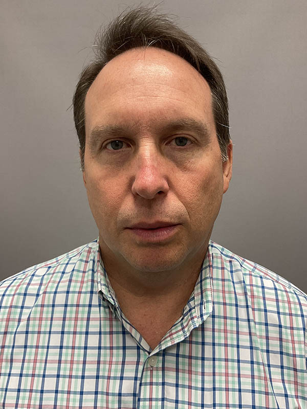 Blepharoplasty Before & After Image