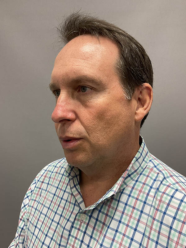 Blepharoplasty Before & After Image