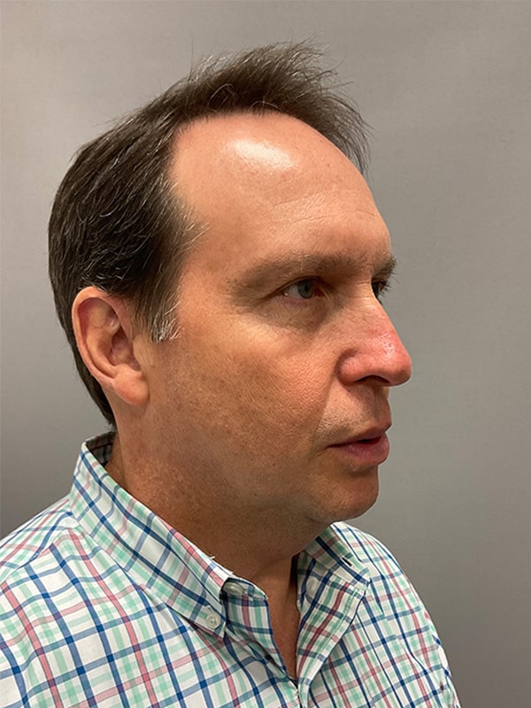 Blepharoplasty Before & After Image