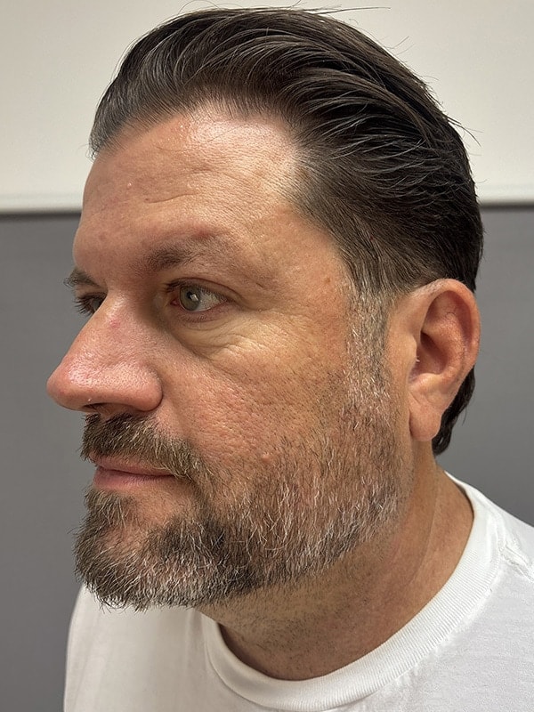 Blepharoplasty Before & After Image