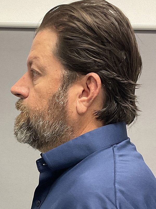Blepharoplasty Before & After Image
