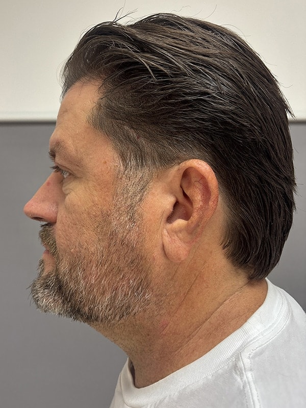 Blepharoplasty Before & After Image