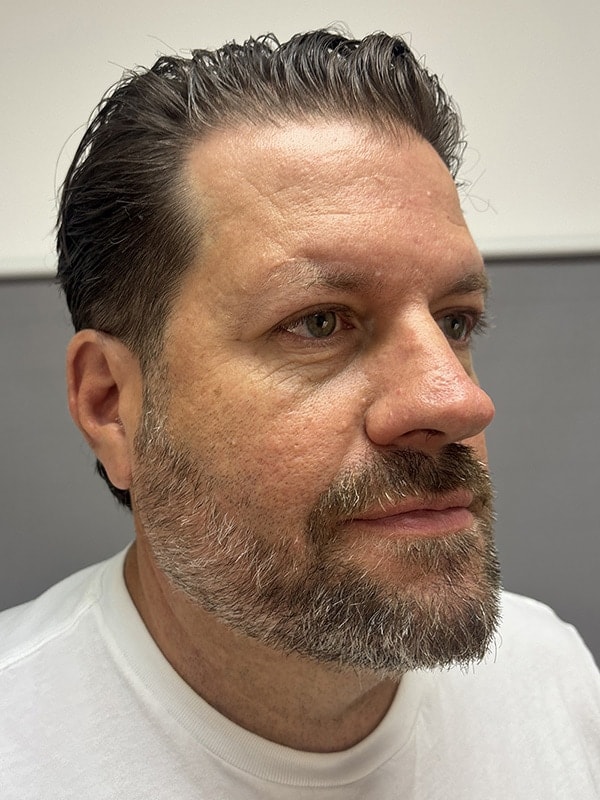 Blepharoplasty Before & After Image