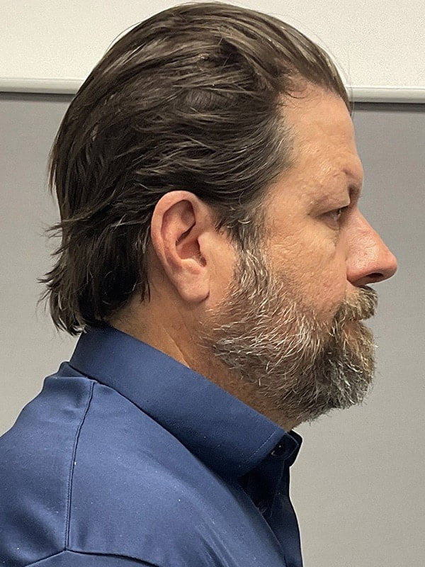 Blepharoplasty Before & After Image